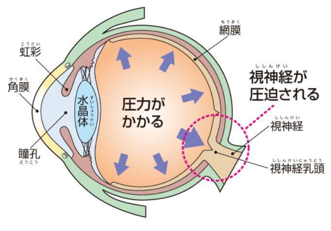 緑内障の詳細